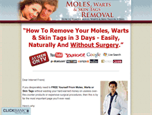 Tablet Screenshot of moleswartsremoval.com